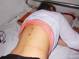 dau_vet_tren_lung_be_vang